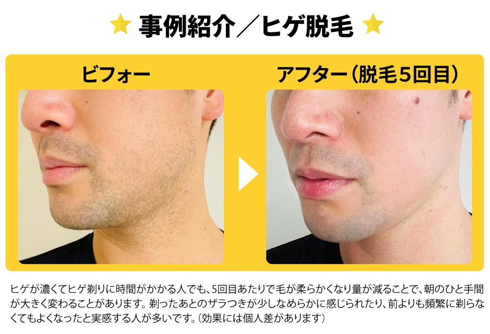 事例紹介／ヒゲ脱毛