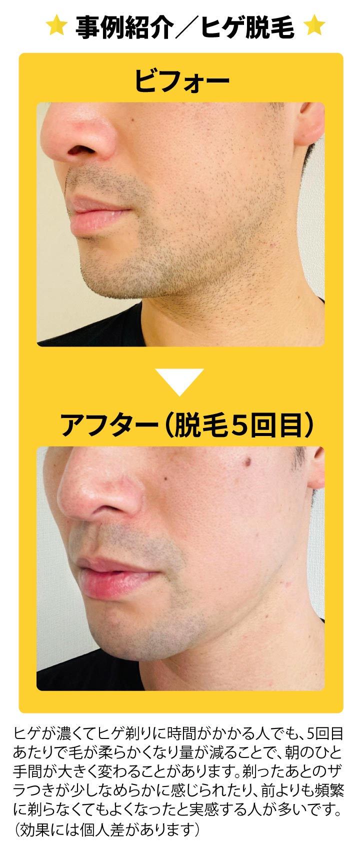 事例紹介／ヒゲ脱毛