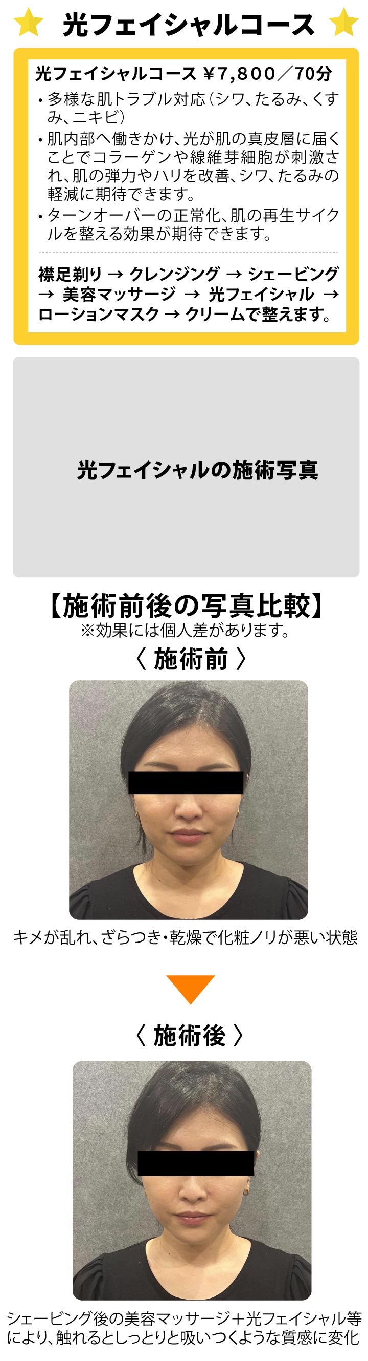 レディースシェービング＆フェイシャルエステ／光フェイシャルコース／肌内部へ働きかけ、光が肌の真皮層に届くことでコラーゲンや線維芽細胞が刺激され、肌の弾力やハリを改善、シワ、たるみの軽減に期待できます。
