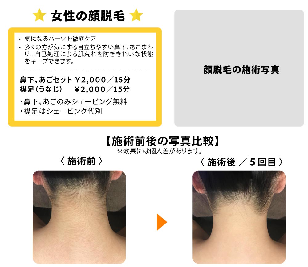 女性の顔脱毛／鼻下・あごセット、襟足（うなじ）／気になるパーツを徹底ケア。多くの方が気にする目立ちやすい鼻下、あごまわり...自己処理による肌荒れを防ぎきれいな状態をキープできます。