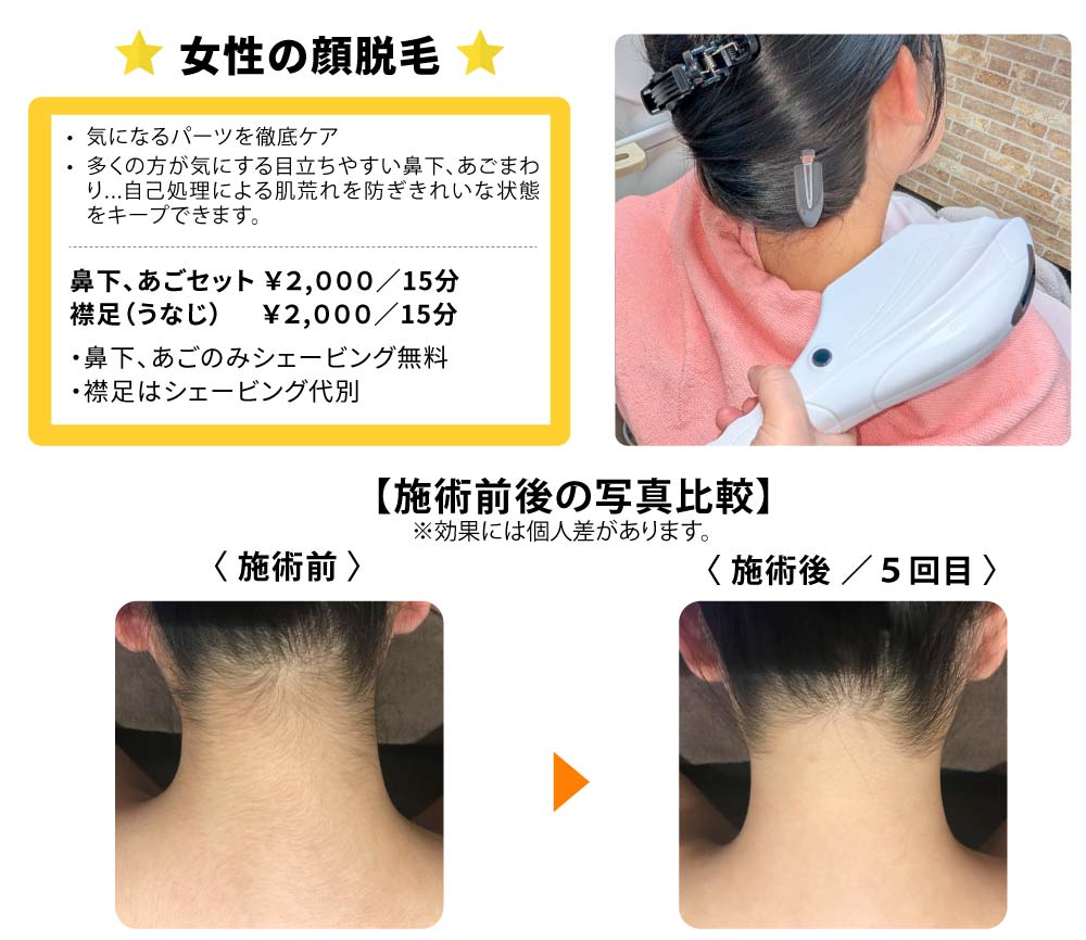 女性の顔脱毛／鼻下・あごセット、襟足（うなじ）／気になるパーツを徹底ケア。多くの方が気にする目立ちやすい鼻下、あごまわり...自己処理による肌荒れを防ぎきれいな状態をキープできます。