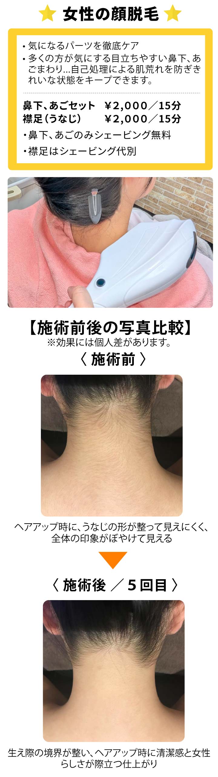 女性の顔脱毛／鼻下・あごセット、襟足（うなじ）／気になるパーツを徹底ケア。多くの方が気にする目立ちやすい鼻下、あごまわり...自己処理による肌荒れを防ぎきれいな状態をキープできます。